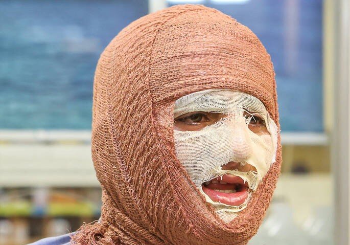 شناخت انواع سوختگی در حملات هوایی در شرایط جنگی