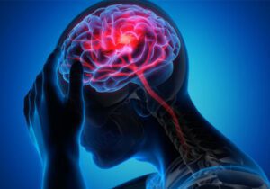 تحریک نخاع به بازیابی قدرت بازو پس از سکته مغزی کمک می کند